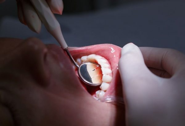test de parodontita