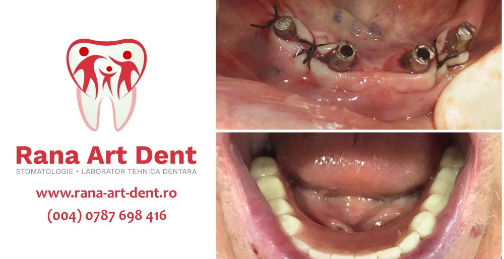 Edentatie Totalasi Implant Dentar Rapid
