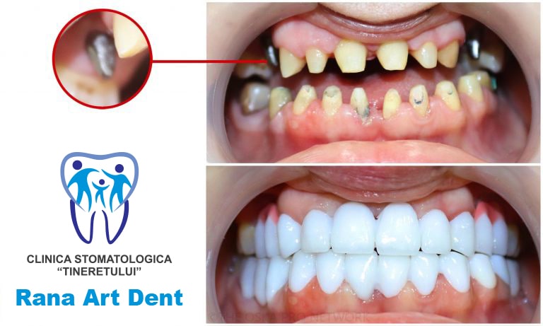 crash Morgue Apartment Implant Dentar Bucuresti - Clinica Stomatologica Rana Art Dent Sector 4 -  Implanturi